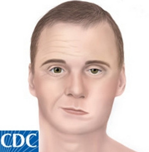 lyme facial palsy how to cum squirt